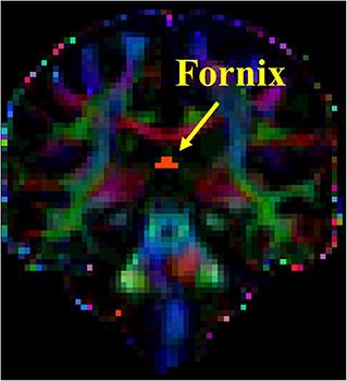 PET Tau Imaging and Motor Impairments Differ Between Corticobasal Syndrome and Progressive Supranuclear Palsy With and Without Alzheimer's Disease Biomarkers